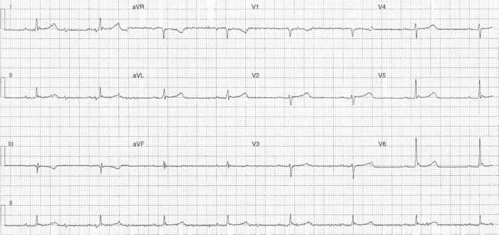 Read more about the article ECG Case 303