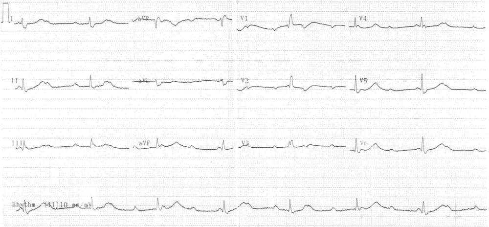 Read more about the article ECG Case 304