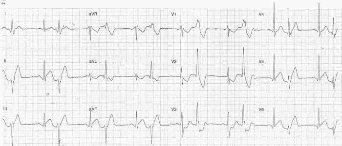 Read more about the article ECG Case 305