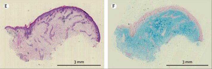 Histopathology of the lesion showing showing myxedema