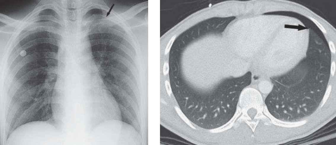 Pneumothorax with Deep Sulcus Sign