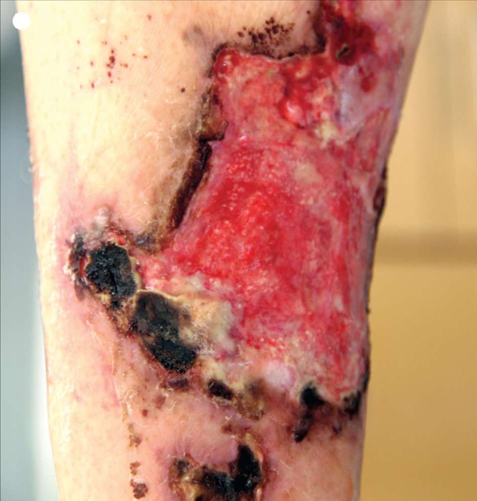 Read more about the article Skin Lesion in a Patient on Haemodialysis