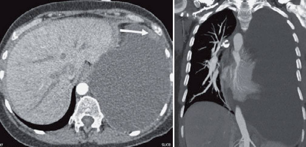 Unilateral Pleural Effusion on Chest CT