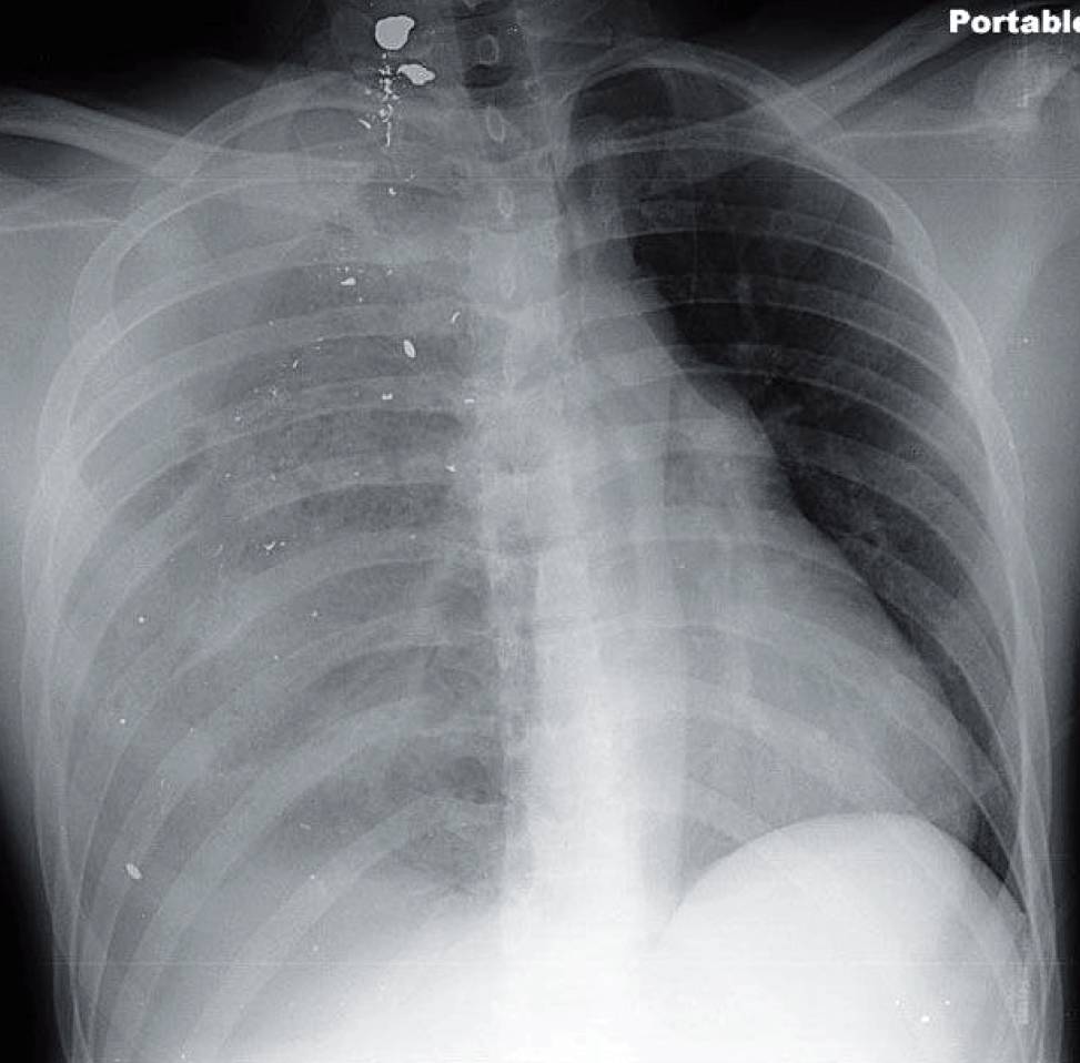 Chest x-ray of 21-year-old man with chest pain and shortness of breath after being shot in the back showing Large Right Tension Hemopneumothorax