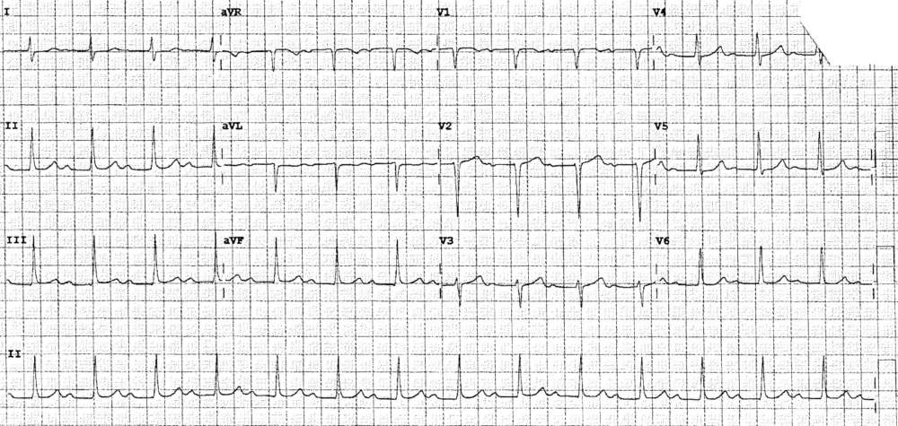 ECG From 1 Month Prior showing 1st degree AV block