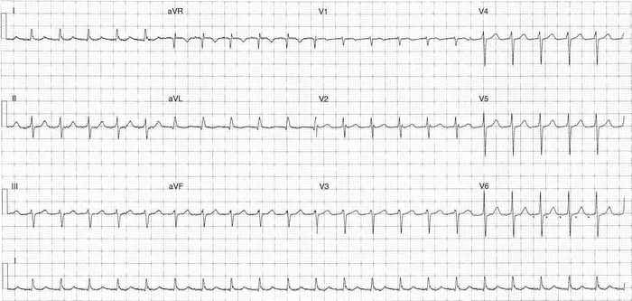 Read more about the article ECG Case 306