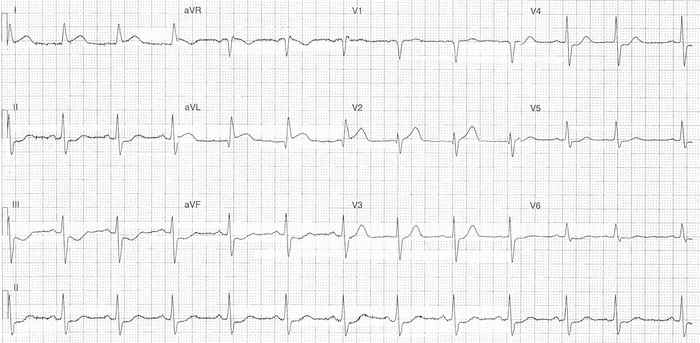 Read more about the article ECG Case 307