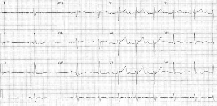 Read more about the article ECG Case 308
