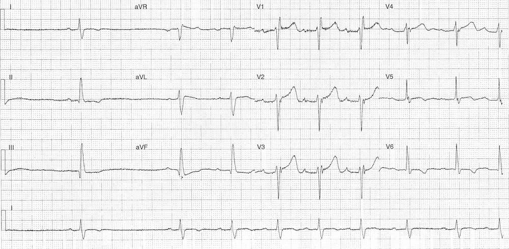 ECG from an 84-year-old male who presented following an episode of syncope in which he sustained a head injury
