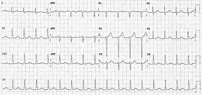 Read more about the article ECG Case 309