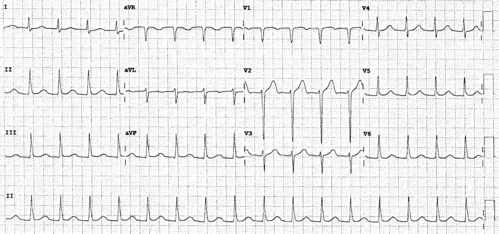 ECG from a 57-year-old male who presented with diarrhea and vomiting