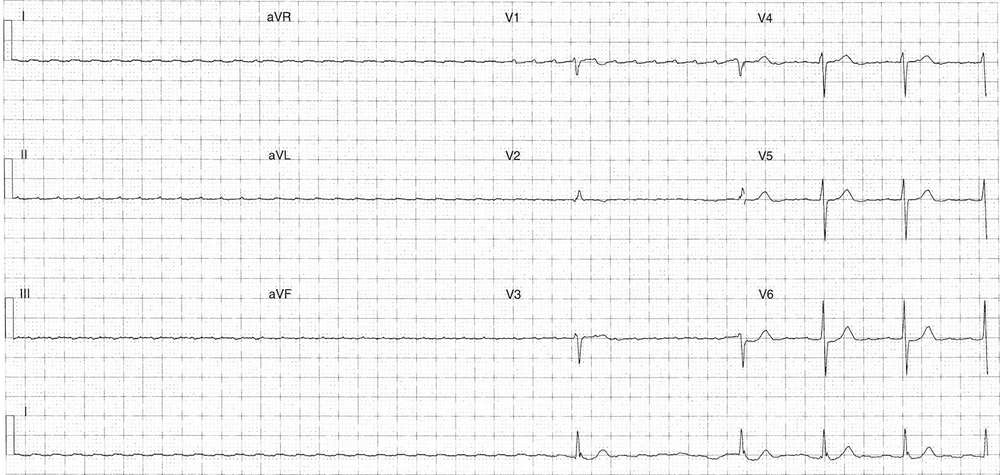 ECG during treatment with adenosine