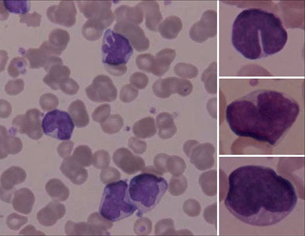 Read more about the article Infant Girl with Respiratory Distress