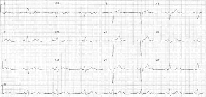 Read more about the article ECG Case 311
