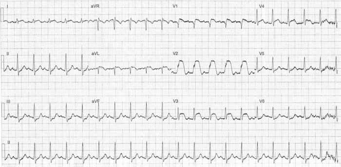 Read more about the article ECG Case 312