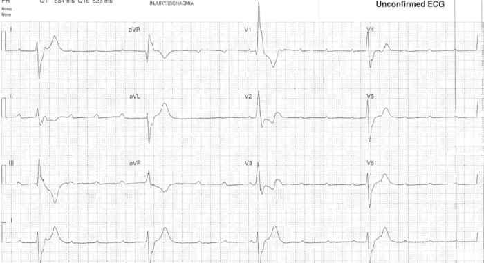 Read more about the article ECG Case 313