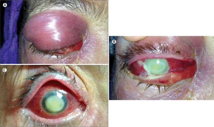 Read more about the article Painful Unilateral Exophthalmos
