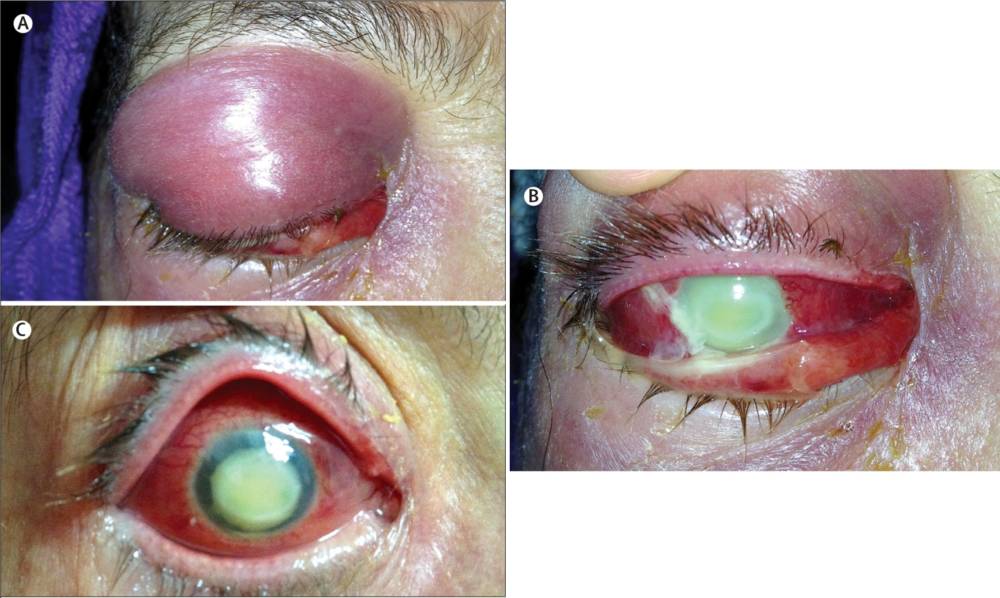 Unlilateral eyelid edema, conjunctival injection, total chemosis, abundant purulent secretions, and a greenish hypopyon occupying the anterior chamber