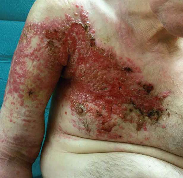 Read more about the article A 70-year-old Man With an Itchy Rash