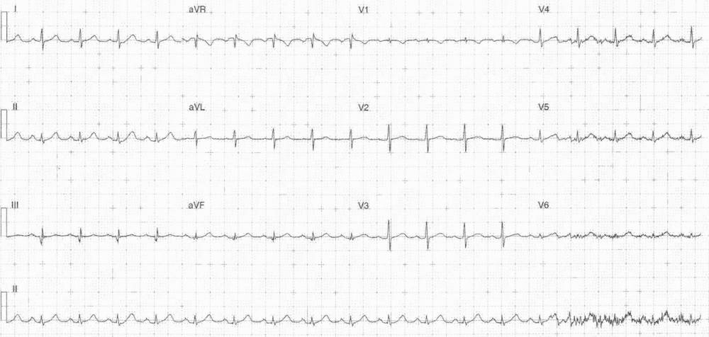 Read more about the article ECG Case 314