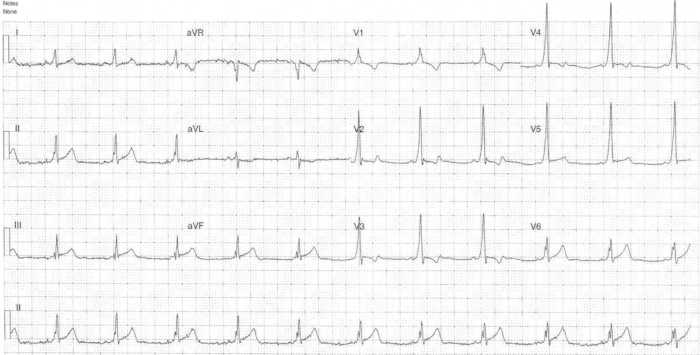 Read more about the article ECG Case 315