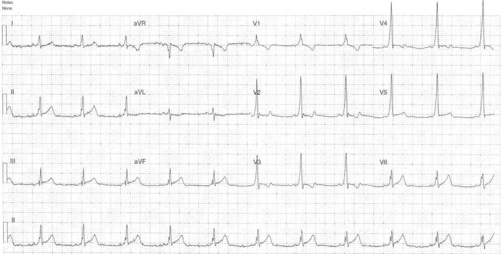 ECG from a 50-year-old male who presented with 2 hours of central chest pain