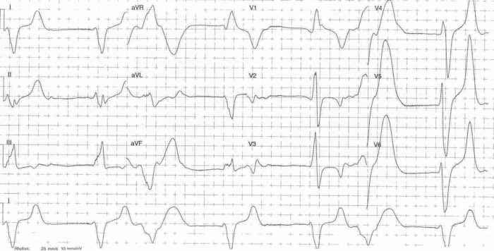 Read more about the article ECG Case 316