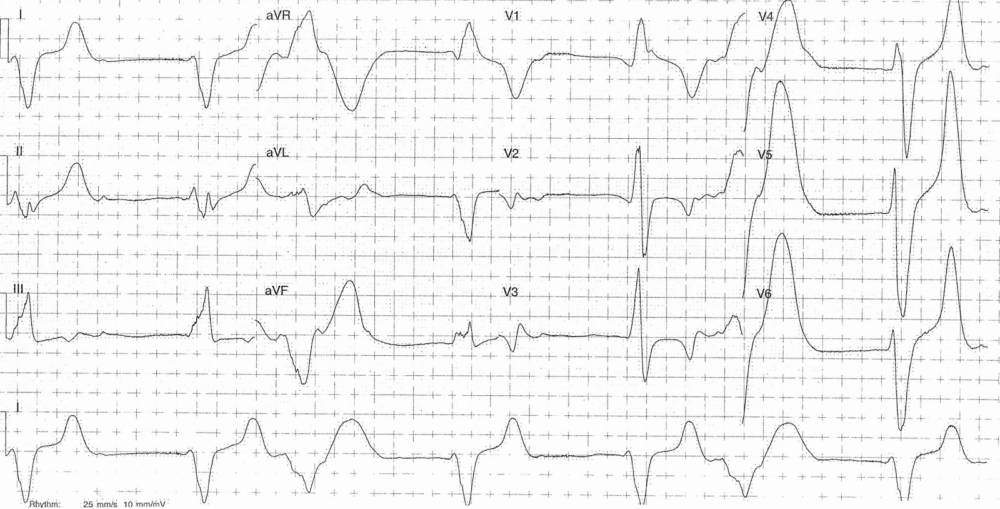 ECG from a 24-year-old female who presented with dyspnea