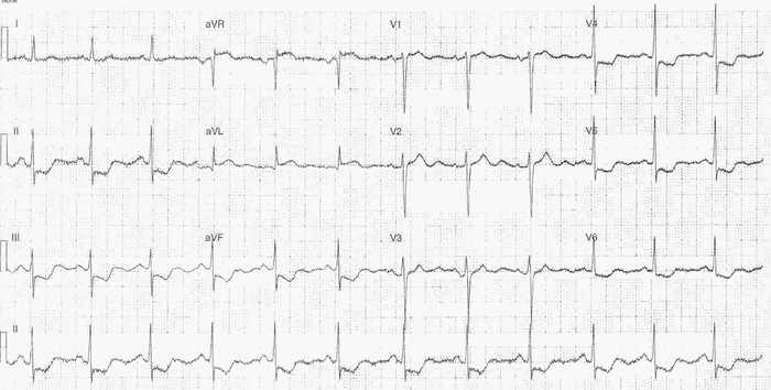 Read more about the article ECG Case 317
