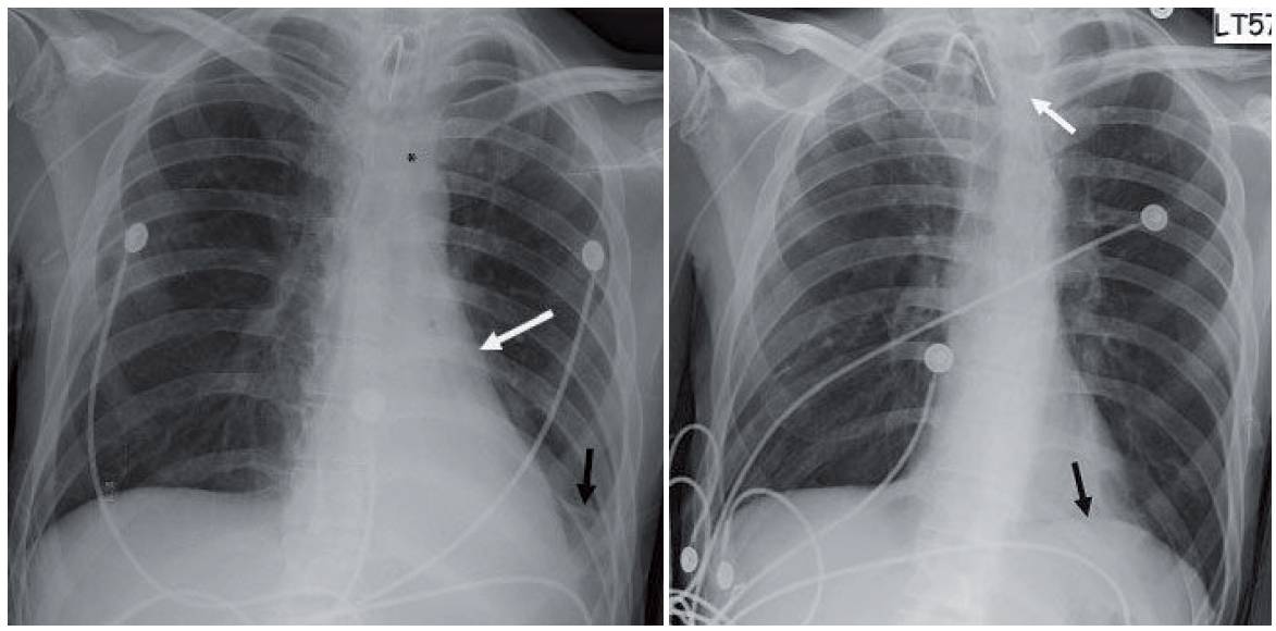 Chest x-ray showing Left Lower Lobe Collapse (from a Mucus Plug)