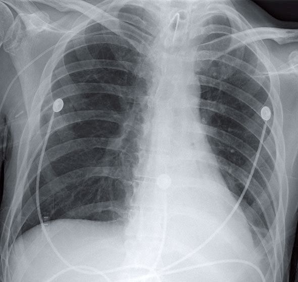 CXR of a Patient with Myasthenia Gravis and Hypoxia