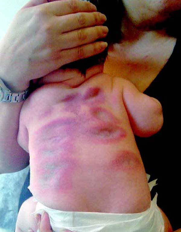 Read more about the article Pink Plaques in a Healthy Infant