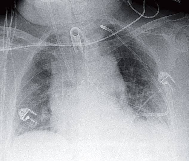 Read more about the article Woman with a History of a Mitochondrial Myopathy