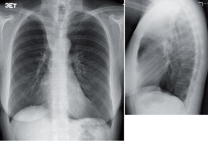 Right Upper Lobe Collapse (from an Endobronchial Carcinoid Tumor ...