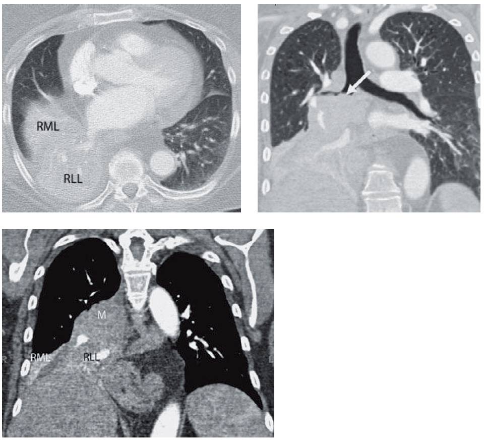 Chest CT showing central mass and collapsed lobes
