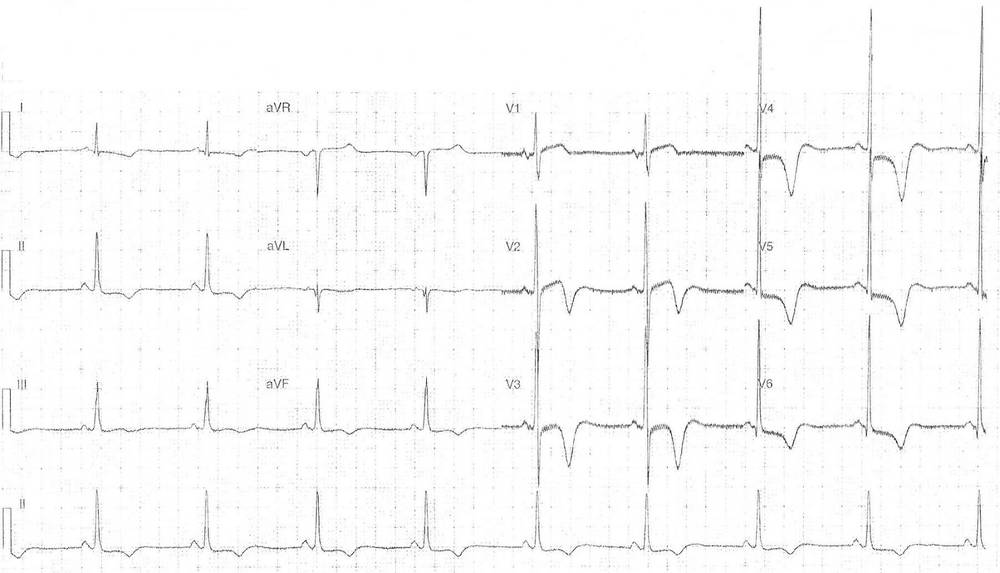 ECG showing Extensive T wave abnormalities with massive precordial QRS complexes (apical hypertrophic cardiomyopathy (Yamaguchi Syndrome))