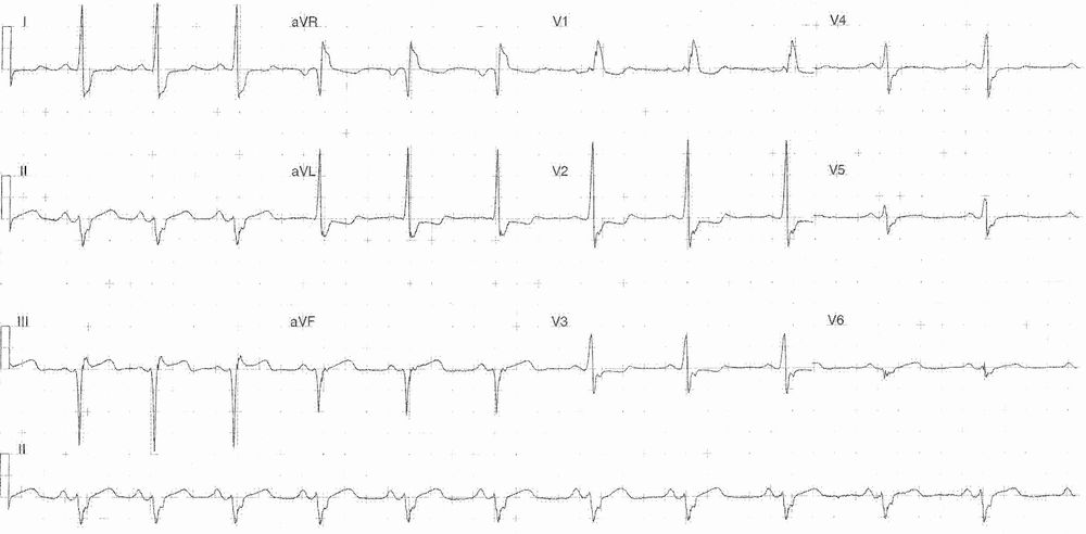 Read more about the article ECG Case 319