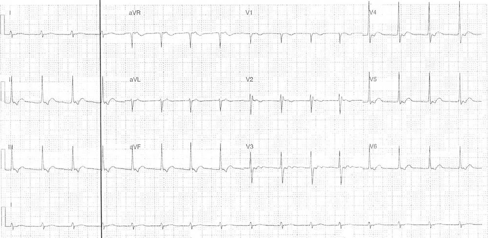 ECG from a 28-year-old female who presented with abrupt onset of chest pain
