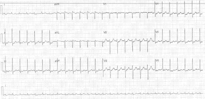 Read more about the article ECG Case 321