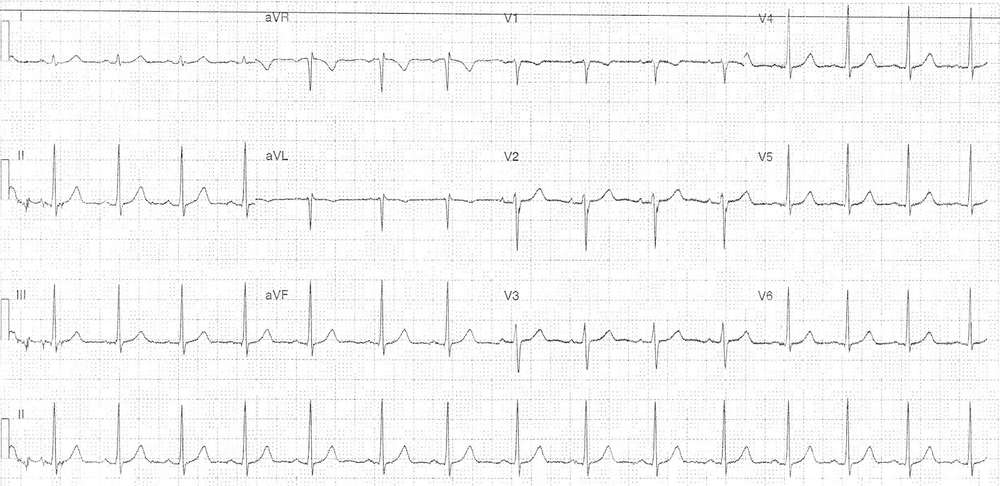 ECG after reverting to sinus rhythm