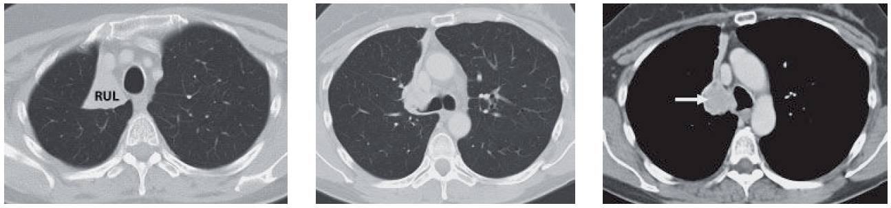 Right Upper Lobe Collapse (from an Endobronchial Carcinoid Tumor ...