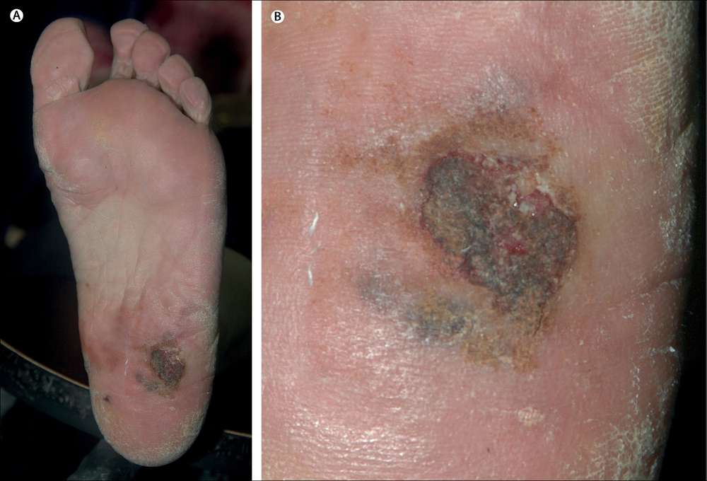 An irregular pigmented macule with a superficial ulceration and brown haemorrhagic crusts was observed on the left plantar near the heel