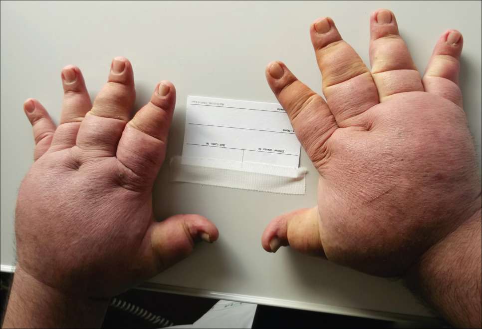 Read more about the article Swelling of the Hands