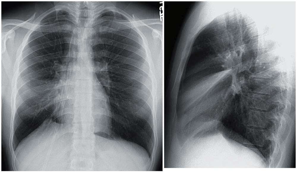 Chest x-ray of a woman with asthma and worsening dyspnea