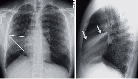 Chest x-ray showing Right Middle Lobe Collapse (from a Mucus Plug)
