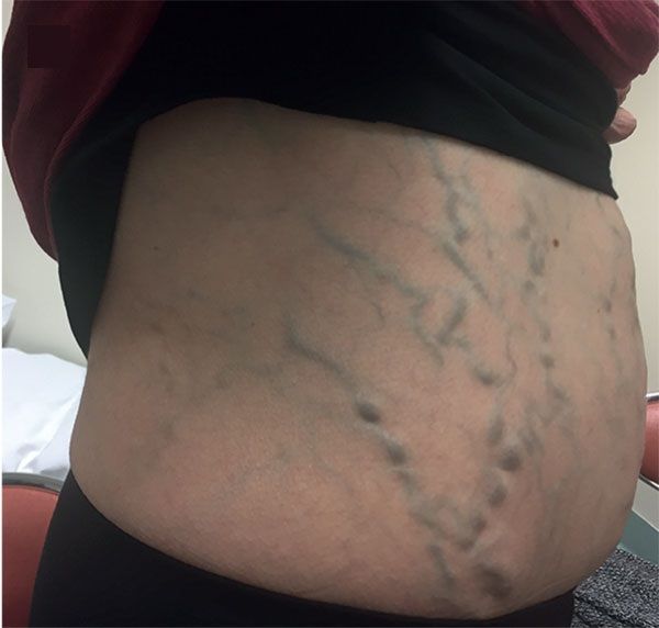 Dilated Abdominal Veins from Budd-Chiari Syndrome and Caval Obstruction