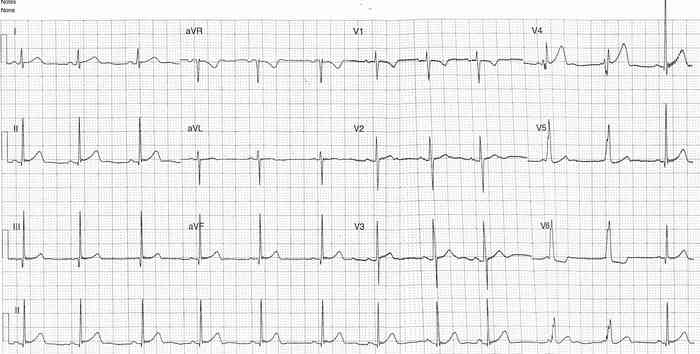 Read more about the article ECG Case 322