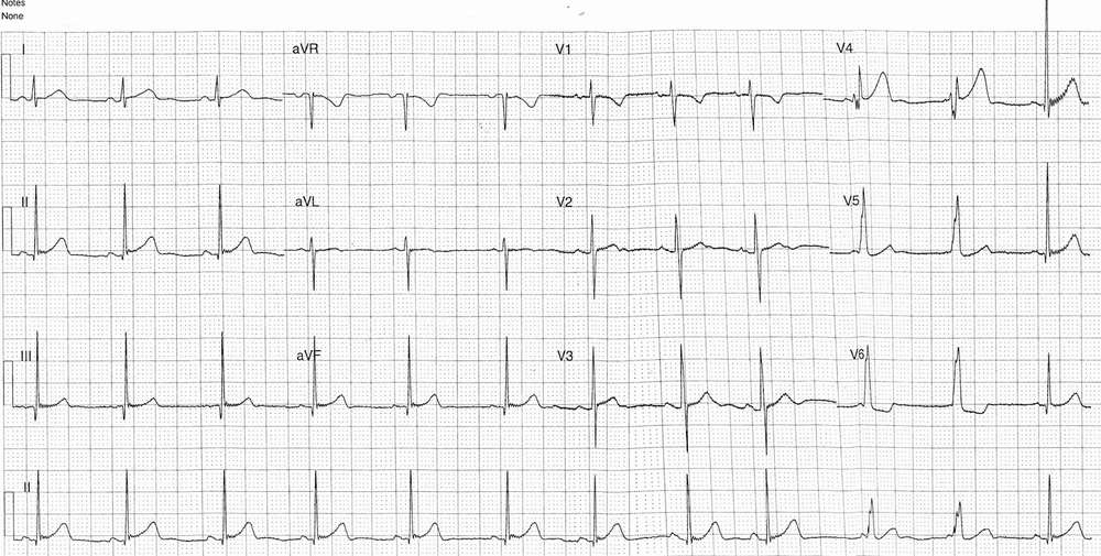ECG from a 12-year-old following an episode of dyspnea and palpitations