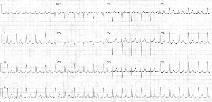 Read more about the article ECG Case 323