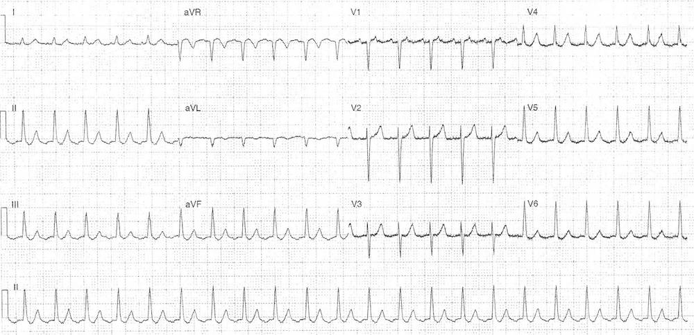 ECG from an 81-year-old female who presented with a 48 hour history of palpitations